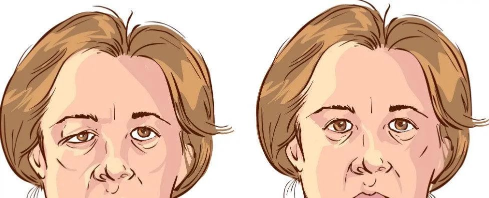 下眼皮下垂是什么原因导致的,一只眼皮下垂什么原因