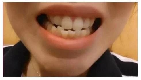 40岁了牙齿龅牙怎么快速矫正,7岁地包天矫正牙齿的全部过程