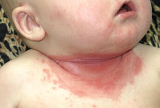 皮肤病常见菌,念珠菌性间擦疹