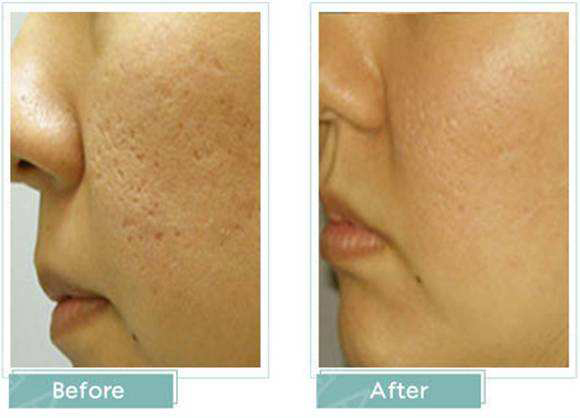 毛孔粗大有痘痘如何改善,毛孔粗大有痘痘的脸怎么办