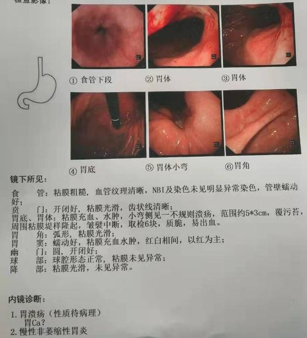胃癌新辅助化疗实战病例分析