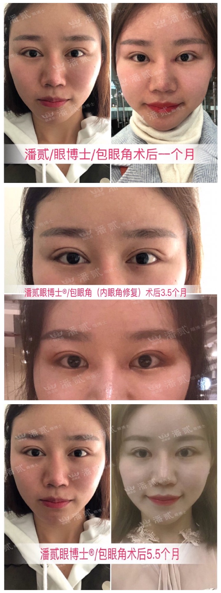 开内眼角会留疤的照片,开内眼角的疤痕变白色了怎么办