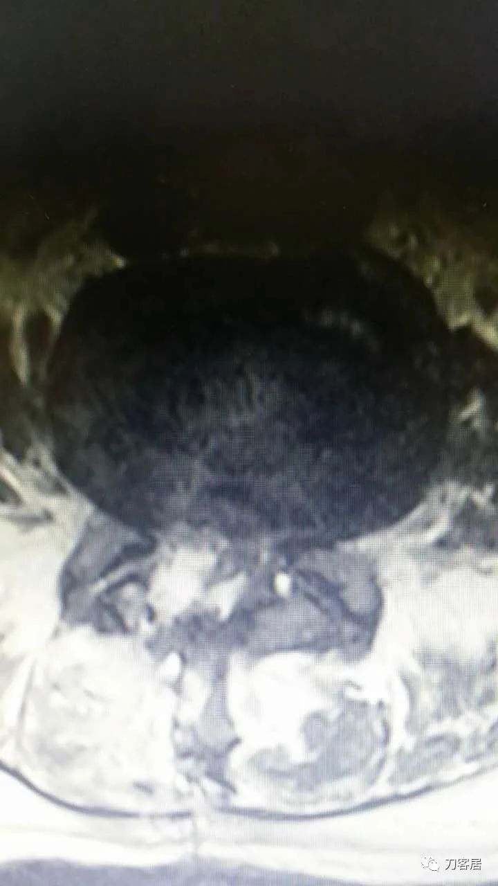 腰椎手术切掉棘突,腰突微创后出血肿