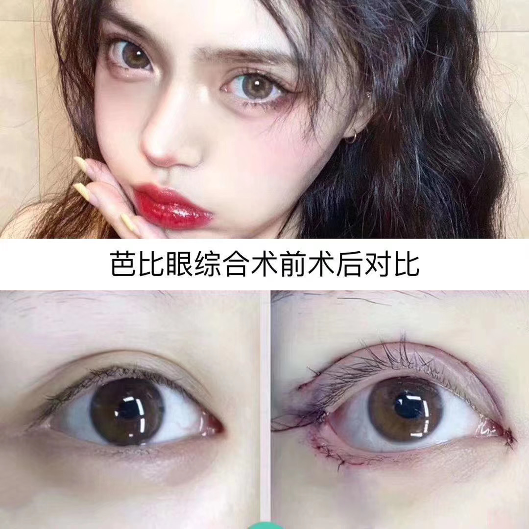双眼皮手术睁眼闭眼效果,双眼皮手术怎么看着不假