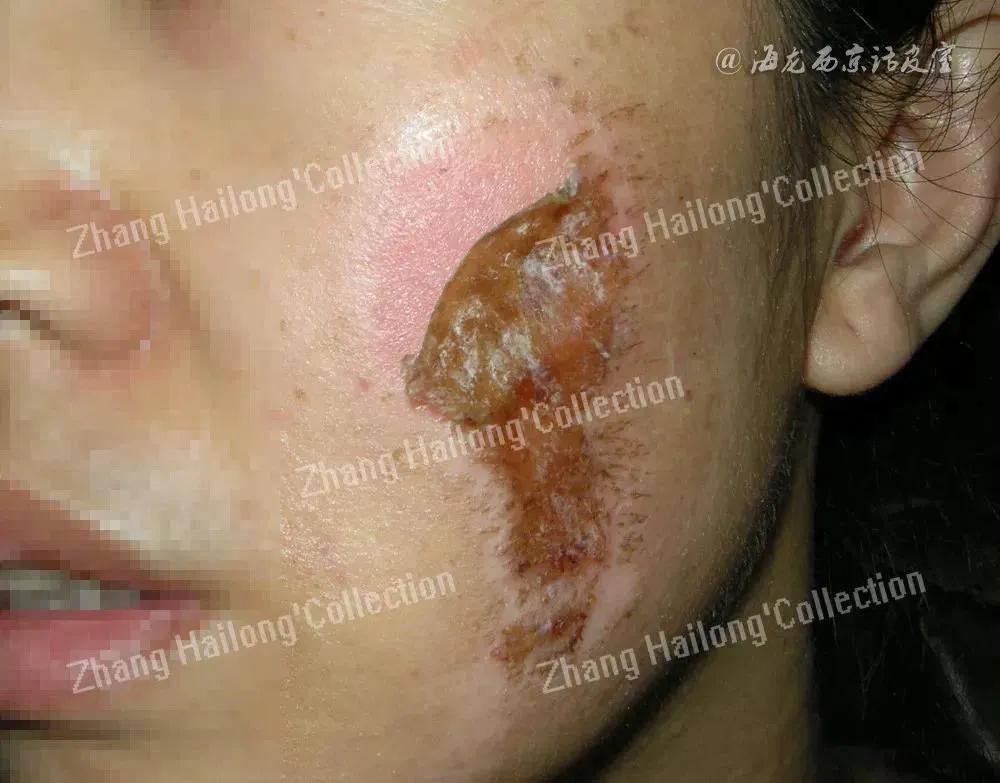 面部擦伤几天结痂,面部擦伤如何处理不留疤痕