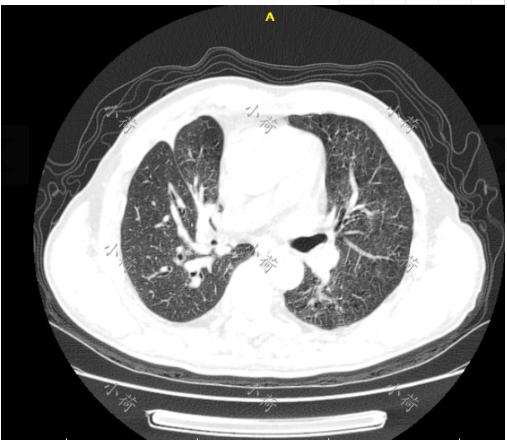 53岁大爷查出艾滋,小伙不幸患上肺癌后又查出艾滋