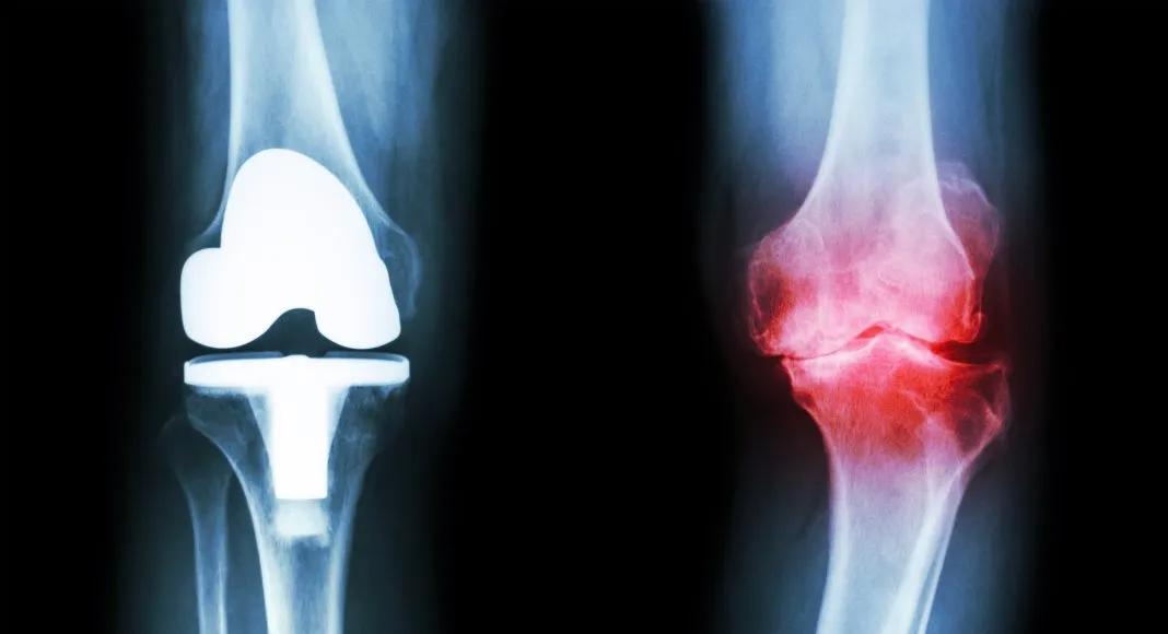 为什么干细胞成为治疗关节疼痛的最佳选择，来看看这些实例