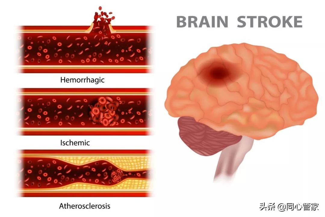 血管狭窄如何扼住生命的咽喉？让你全身器官都遭殃