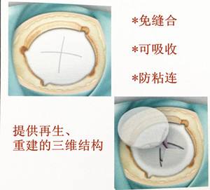 张医生大白话：一文读懂脑膜瘤