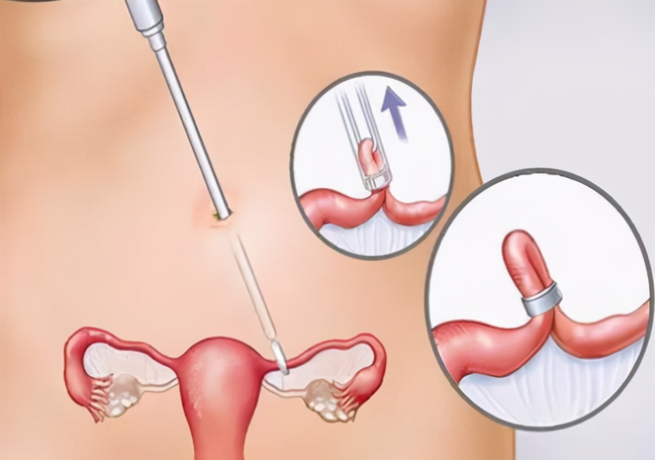 女性结扎后卵子排到哪里了,结扎后排出的卵子去哪了