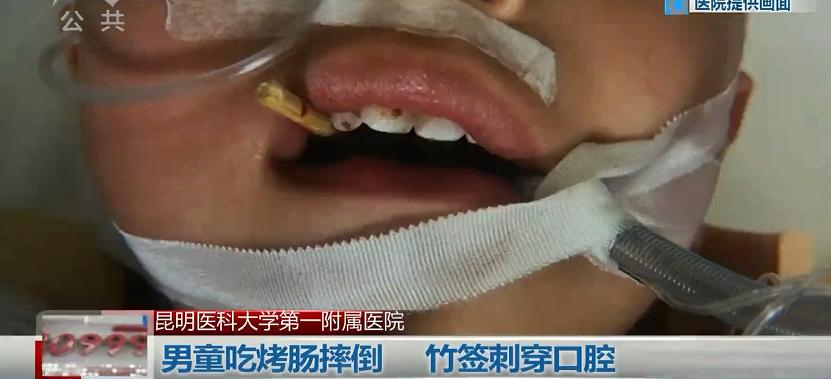 吃烤肠被竹签刺穿咽喉，医生：如果再刺深一点，孩子可能就当场死亡了