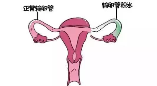 输卵管积水什么时间会倒流,什么情况下输卵管积水会倒流