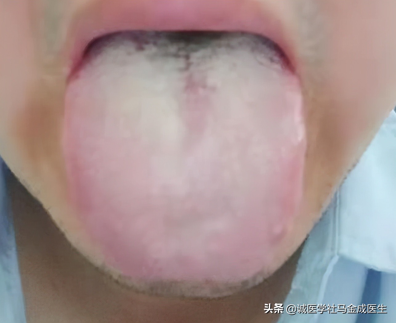 麻疹鉴别视频,荨麻疹寒热怎么治疗