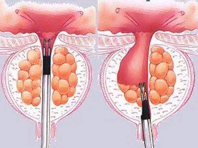 前列腺还能长结石？医生指出：4个危害还很严重，9项措施远离它