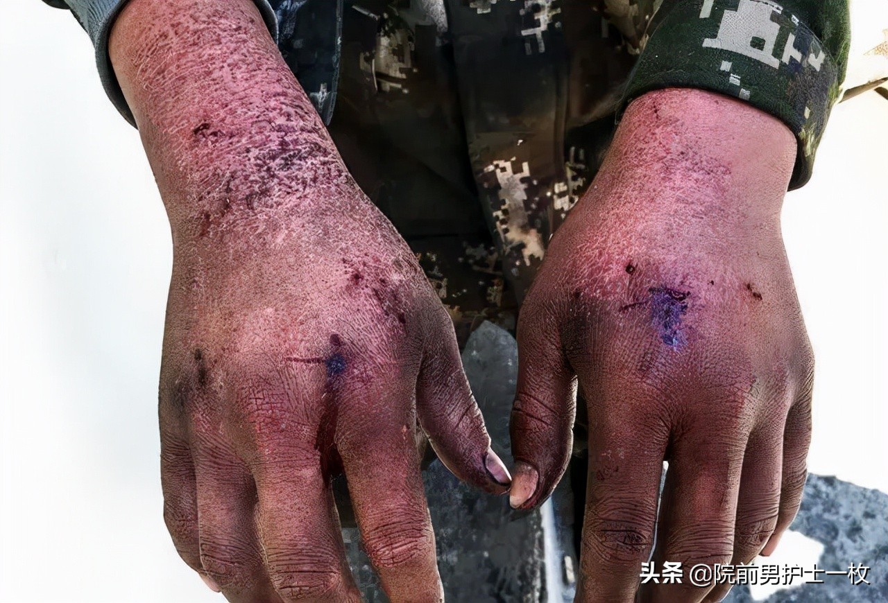 长津湖冻伤多严重,长津湖冻伤救治