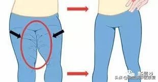 女性盆底健康问题,针刺要扎三阴交,手法要选内收肌