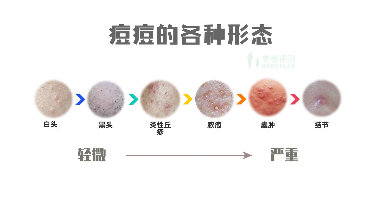 反复出现的痘痘怎么快速消除,烦人的小痘痘