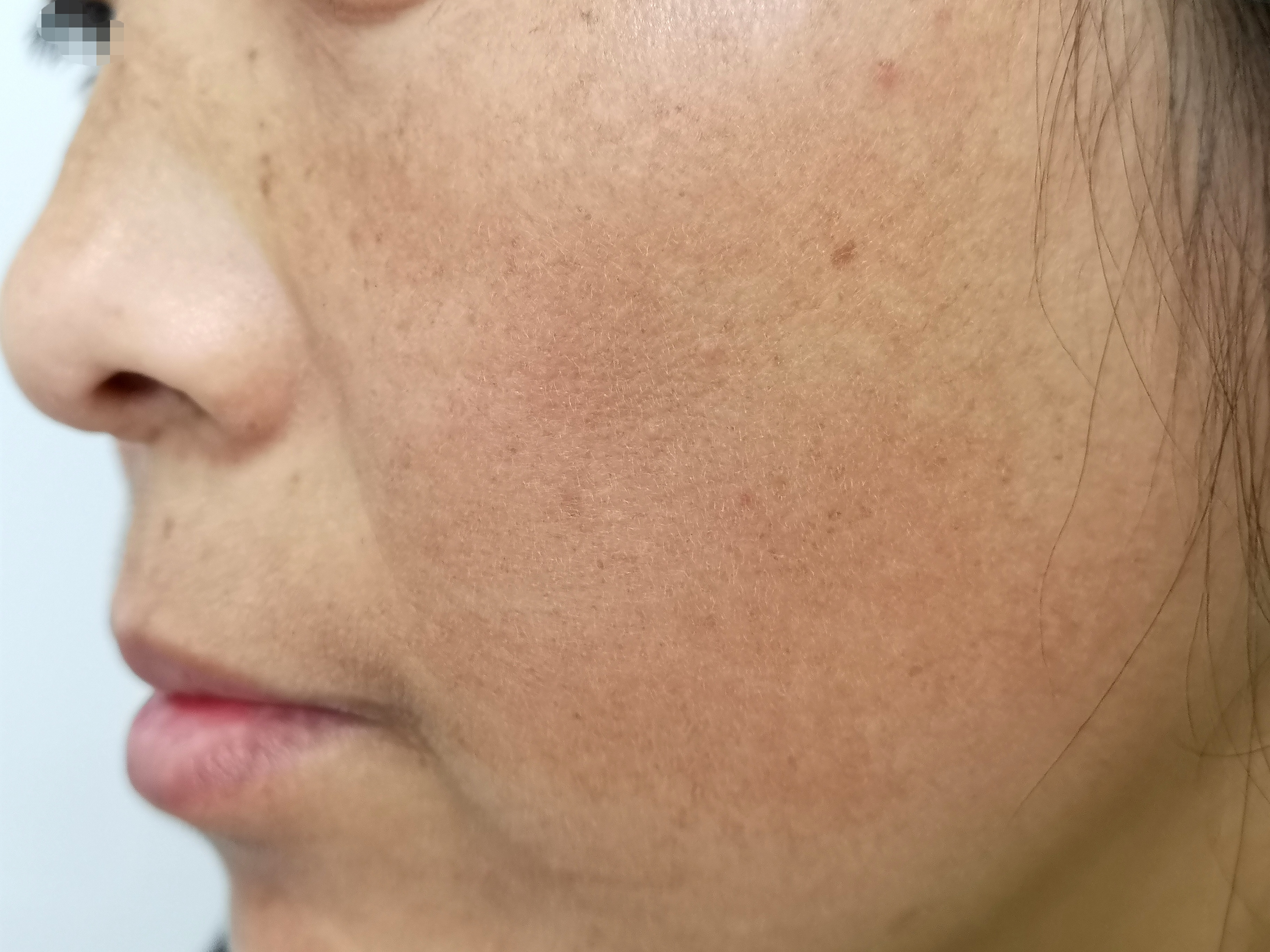 斑需要如何治疗,斑多如何调理