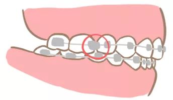正畸疫情复诊,口腔科应对新冠疫情的控制措施