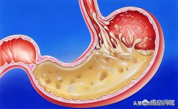 肠胃镜误区,揭秘胃镜检查的几大误区