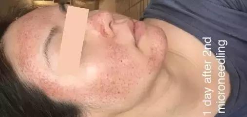 美容微针毁容视频,微针美容副作用怎么修复