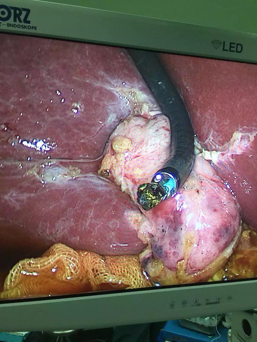 胆管结石和胆囊切除需要多长时间,胆管结石胆囊也切除手术后的饮食