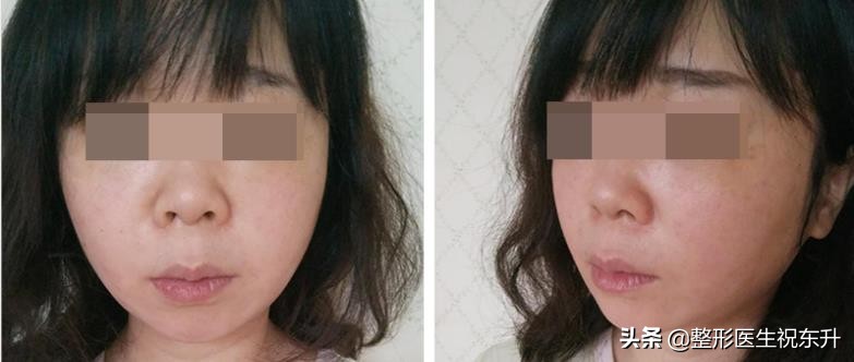 40岁-50岁上下，对抗面部松弛这些“弯路”请绕行？