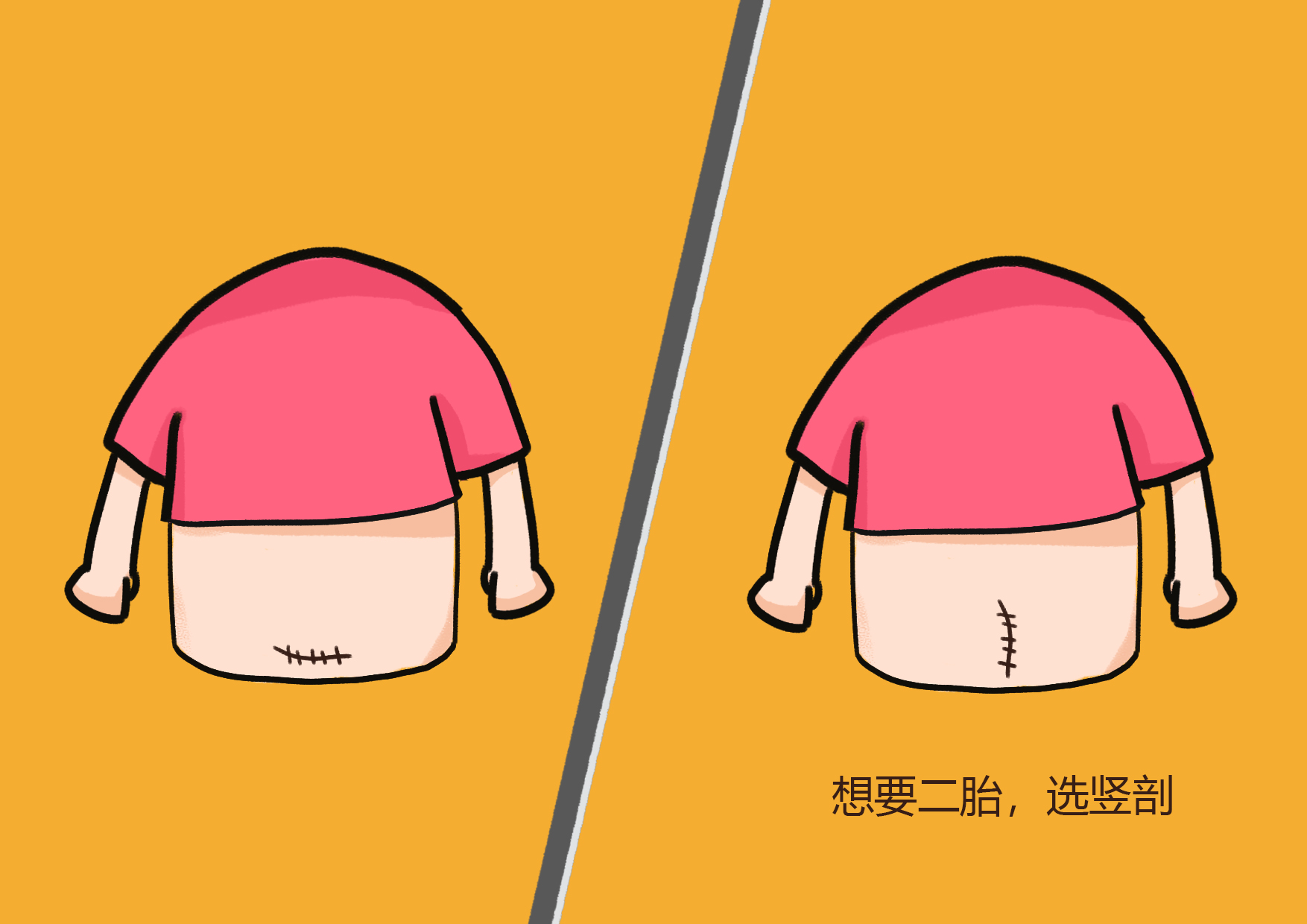 剖腹产术后粘连是什么情况?高发人群有这两种,能顺就别剖了!