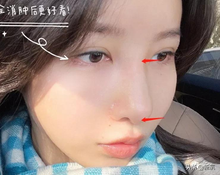 网红整鼻子整出坑,千万网红被坑