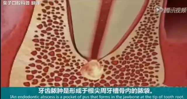 上牙龈上火突出一个鼓包,牙龈肿胀鼓包上火了吗