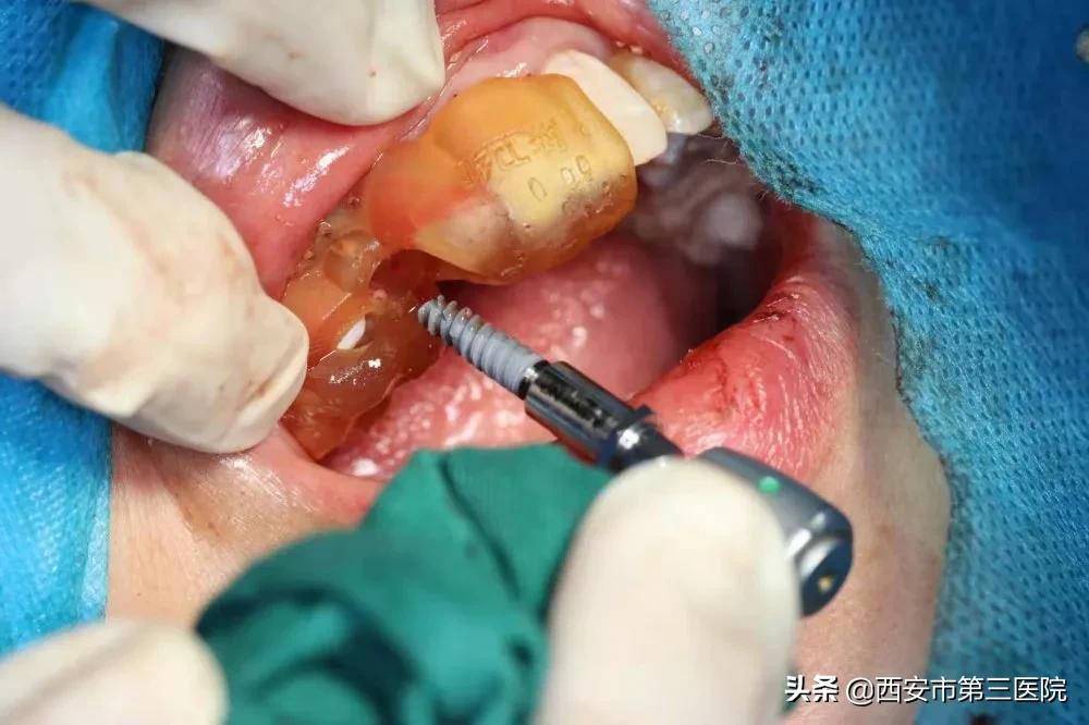 关注口腔健康的策划案例,关注口腔健康数字化种植牙