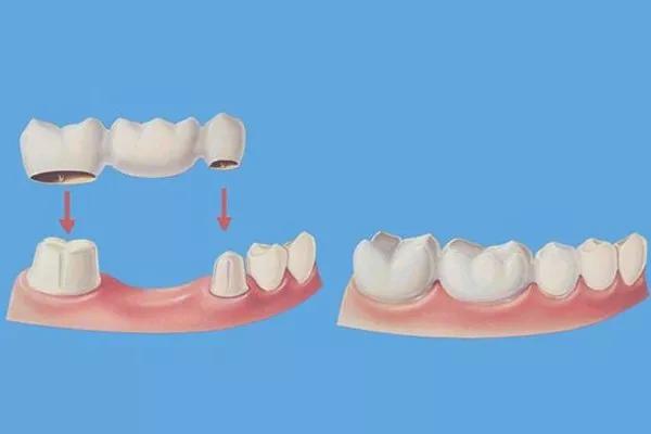 缺了一颗牙不影响吃饭,缺了一颗牙不补
