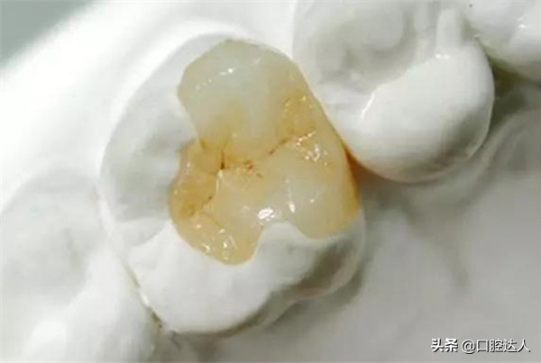 后牙选什么材料补牙,补牙材料太多啦感觉牙不舒服