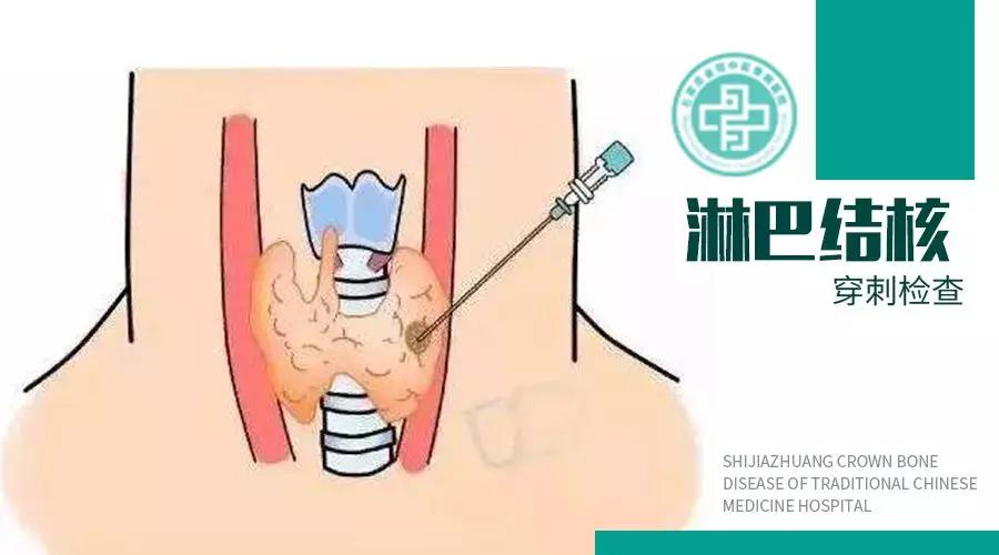 脖子上有个小肿块怎么回事,脖子上出现肿块是肿瘤吗