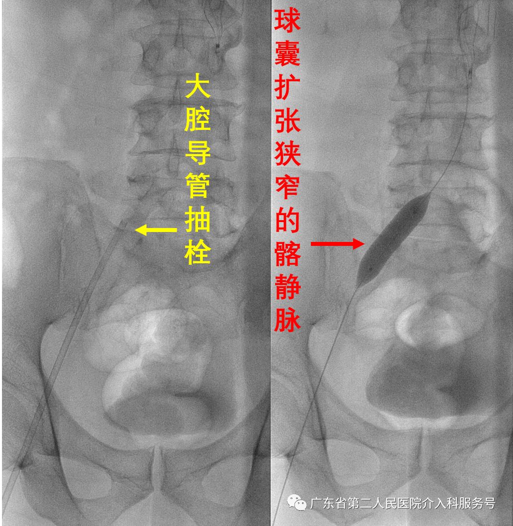 左腿血栓肿胀能完全恢复正常吗,左腿血栓肿痛怎么锻炼
