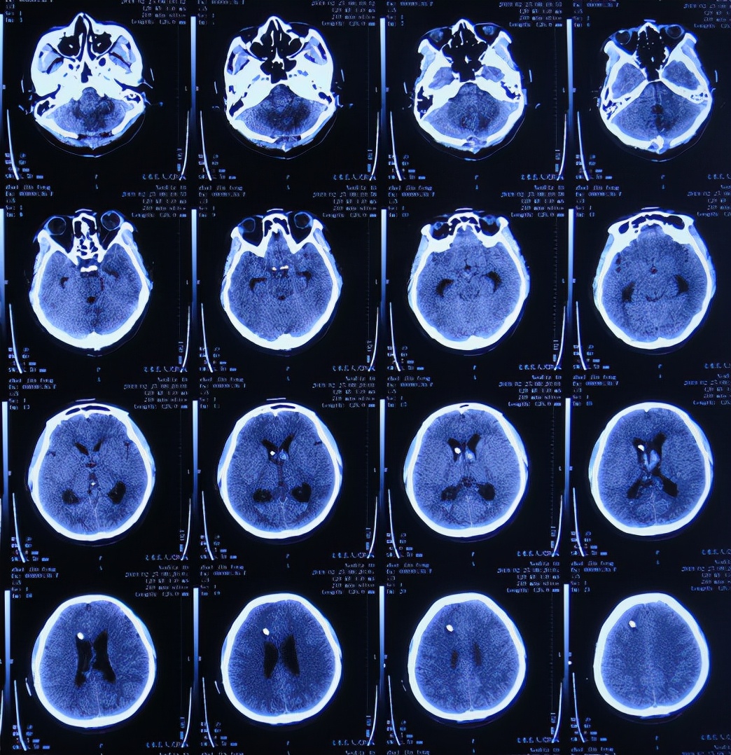 脑出血后脑积水会造成意识不清吗,脑出血后脑积水发高烧危险期多久