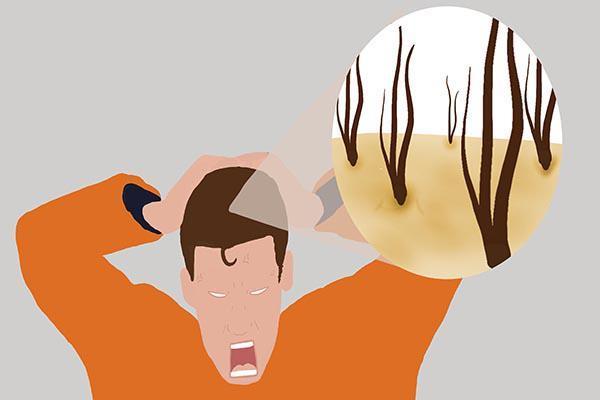 头发痒痒的一抠指甲有白泥,一抓头皮指甲里就有白泥怎么办