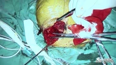 肩锁关节脱位手术后多久可以喝酒,肩锁关节脱位钢板内固定步骤记录