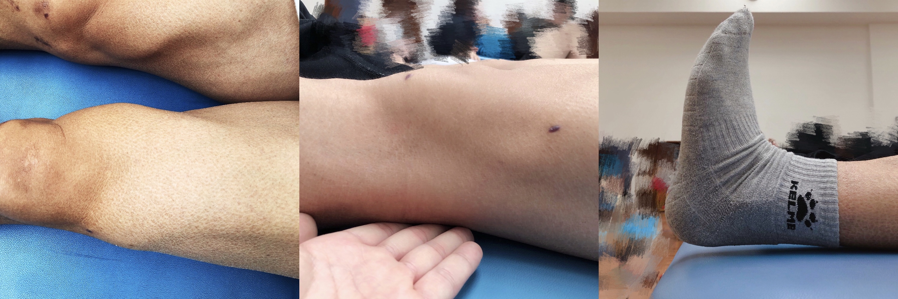 康复锻炼高抬腿正确做法,术后直抬腿的正确训练方法