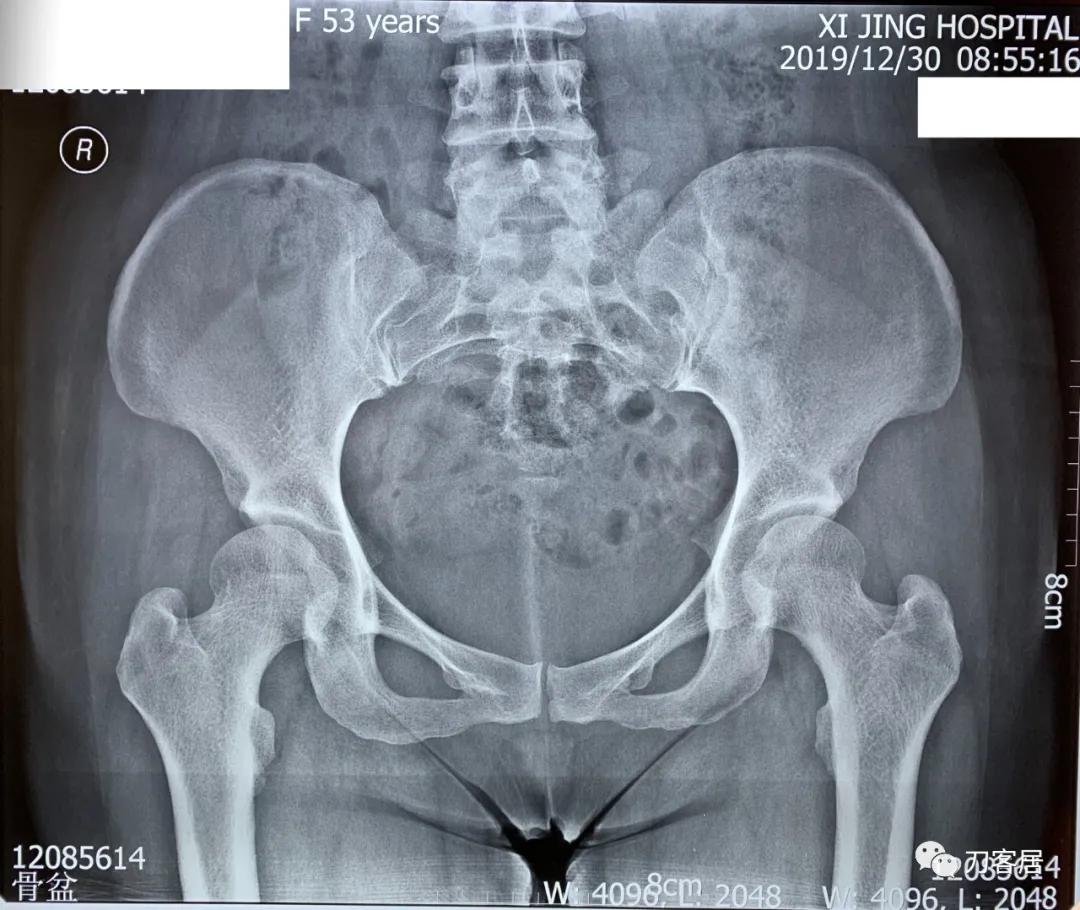 髋关节骶管囊肿,骶管囊肿手术后右腿还是疼咋回事