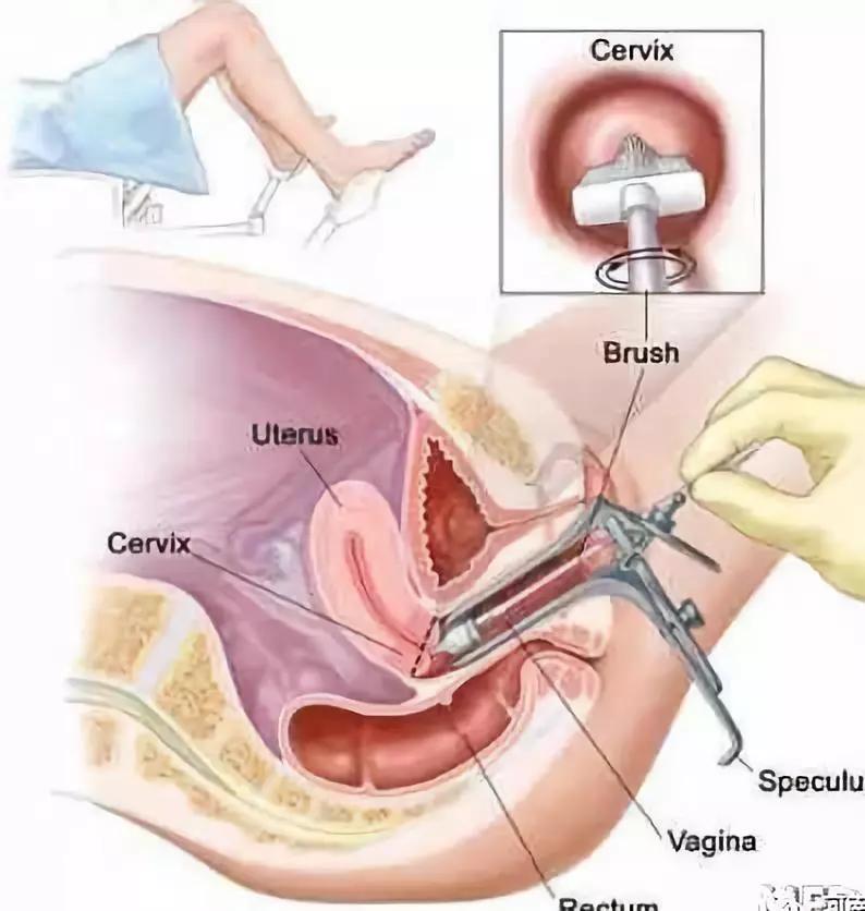 你知道什么是宫颈糜烂吗?