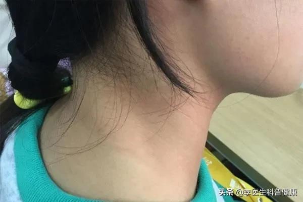 甲状腺亢进饮食注意啥,甲状腺功能亢进注意哪些饮食