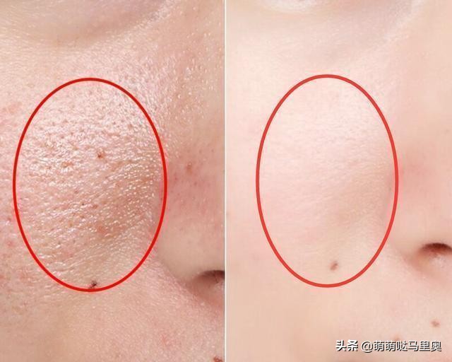 把鼻子里的黑头连根拔起,黑头怎么挤不痛又快