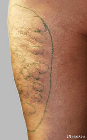 抽脂和吸脂后有什么注意事项,吸脂手术的危害和后遗症