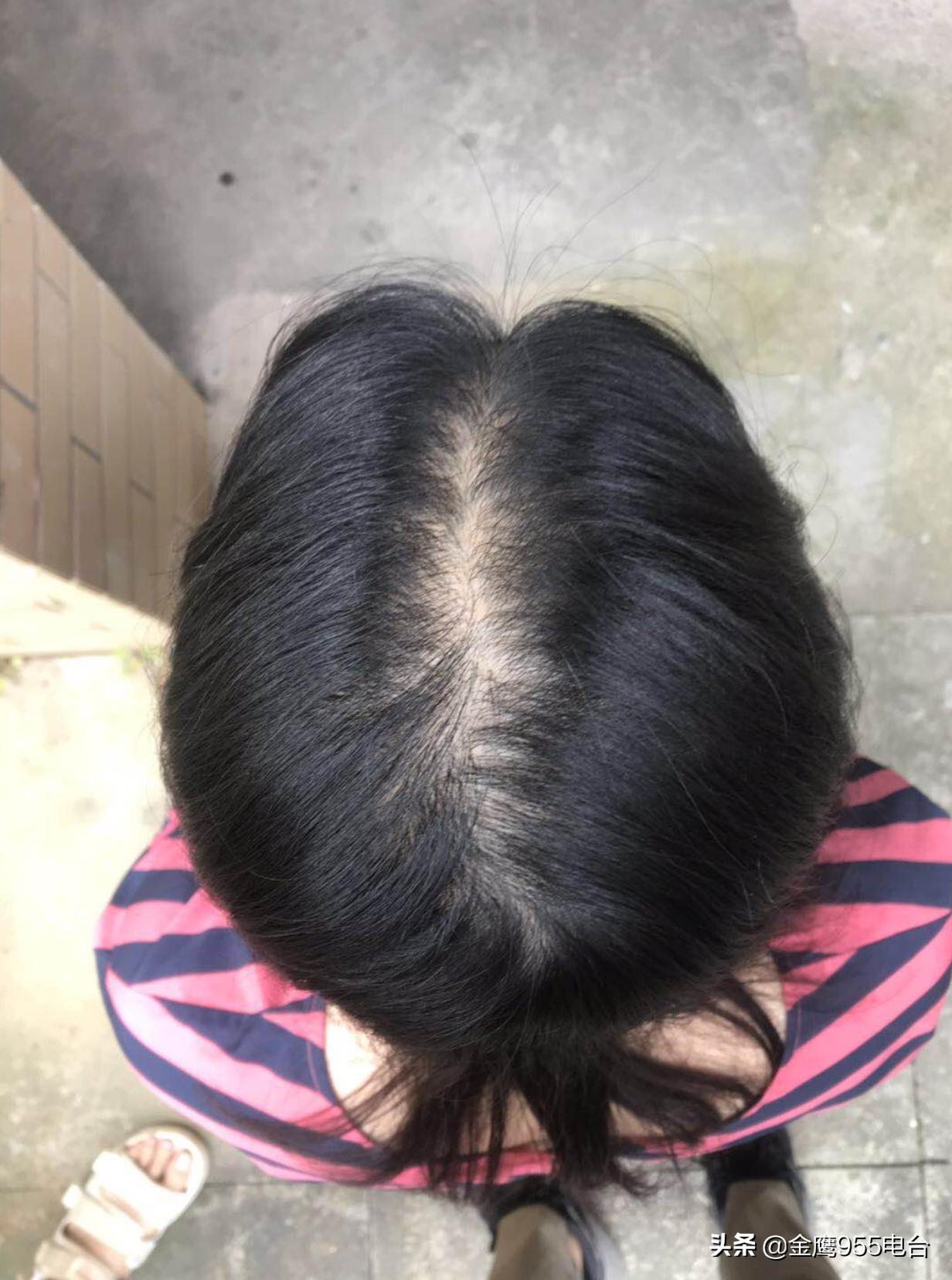 养发馆真的能治脱发吗,养发馆真的可以治脱发吗