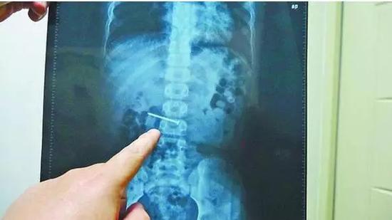 消化内科怎么治疗胃液过多,消化不良和胃酸过多的区别