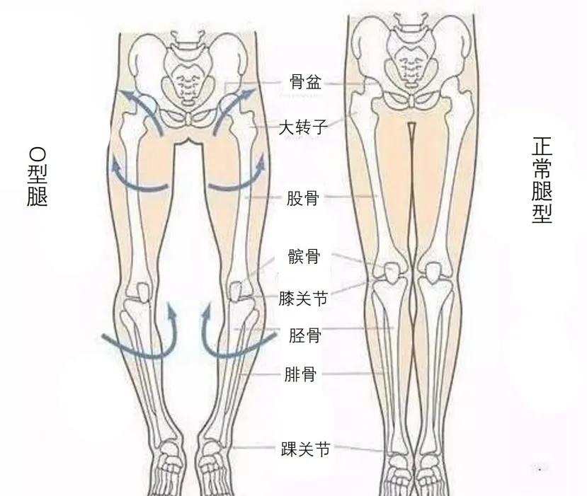 小腿代偿性腿粗怎么走路,小腿粗是因为没拉伸大腿吗
