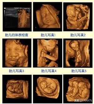 “四维彩超”主要查这些，准妈妈你都知道吗？