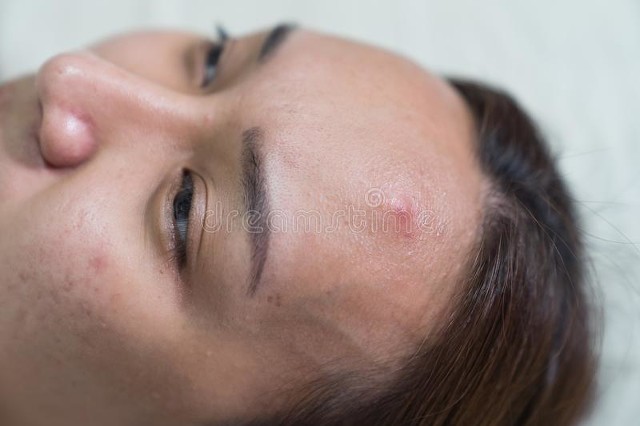 脓包有白色脓点能挤吗,痘痘挤出来的白色乳浆要挤吗