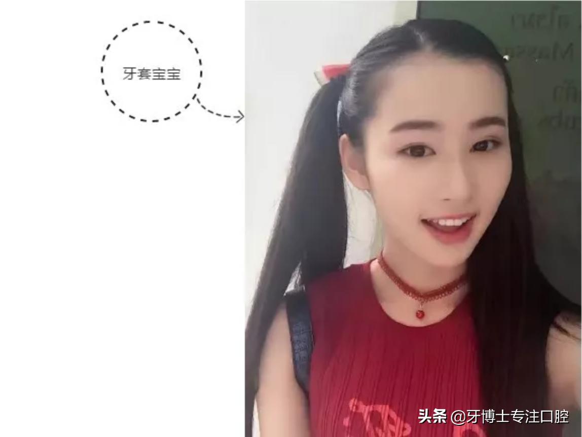 明星牙齿矫正前后对比,明星牙齿矫正都用的什么矫正方式